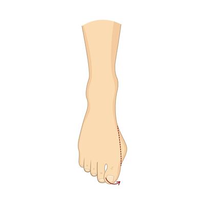 bunion surgery correction. Orthopedics health