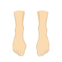 Bunion problem. Orthopedics bunion health vector