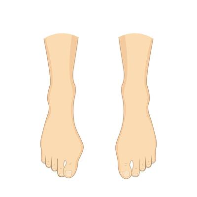 Bunion problem. Orthopedics bunion health