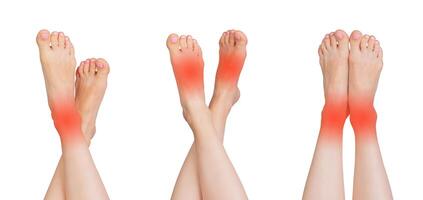 Set of female feet showing signs of pain, injury, and inflammation, including redness and swelling. photo