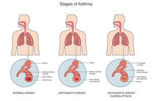 Asthma is a chronic condition causing airway inflammation, wheezing, coughing, and breathlessness vector