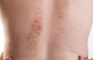 Redness and irritation on the skin of a man s back after a massage. Pimples and red spots with bruises on the skin, close-up photo