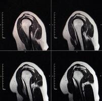 MRI image of the shoulder joint after a fracture and dislocation. Impression fracture of the humeral head. Damage to the joint capsule, joint deformation, arthrosis, close-up photo