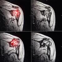 MRI image of the shoulder joint after a fracture and dislocation. Impression fracture of the humeral head. Shoulder injury, sprain, synovitis. The redness and inflammation are red on the MRI image. photo