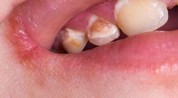 Insufficient hygiene of children's primary teeth. Destruction of enamel and development of caries, close-up photo