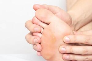 Man shows problem skin on the foot and sole of the foot dry and callous skin with mazols with a stem, close-up, copy space, disease photo