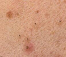 Black dots on face and pimples macro, comedo photo