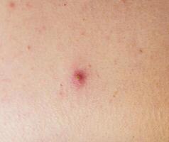 Red pimple on face macro, abscess and acne photo