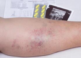 Female elderly leg with varicose veins, next to it is an examination, an ultrasound scan and a tablet for varicose veins, close-up photo