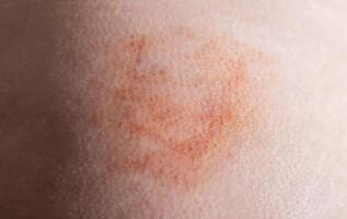 Bruise and subcutaneous lump on the patient s skin after injections. Post-injection infiltrates, close-up photo