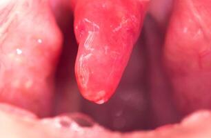 Uvulitis and sore throat in the oral cavity due to illness. Inflammation of the uvula and tonsils due to infections during illness, close-up, streptococcus photo