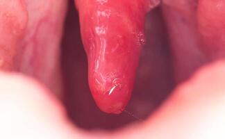Uvulitis and sore throat in the oral cavity due to illness. Inflammation of the uvula and tonsils due to infections during illness, close-up, streptococcus photo