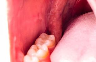recess after complex impacted wisdom tooth extraction, traumatic healing. Dry socket, alveolitis, macro. Copy space for text photo