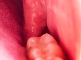 recess after complex impacted wisdom tooth extraction, traumatic healing. Dry socket, alveolitis, macro. Copy space for text photo