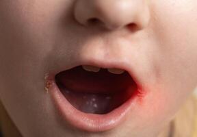 Seizures on the corners of the lips of a child s mouth. Bacterial disease of inflammation of the corners of the lips. Angular stomatitis with reduced immunity in a child, macro photo