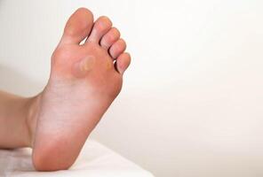 A person's foot has a large callus on its foot due to rubbing from uncomfortable shoes. Rod wart on the sole of the foot, close-up. Copy space for text photo