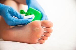 Treatment of a callus on the foot with a special solution after surgery to remove the callus and wart. Copy space for text photo