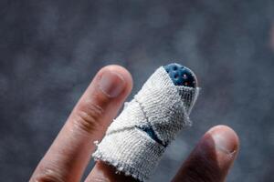 Mallet finger with custom orthosis on the middle finger to immobilize the last phalanx following joint trauma photo