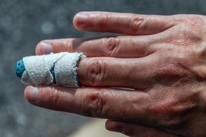 Mallet finger with custom orthosis on the middle finger to immobilize the last phalanx following joint trauma photo
