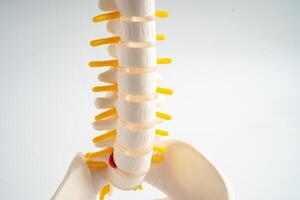 Lumbar spine displaced herniated disc fragment, spinal nerve and bone. Model for treatment medical in the orthopedic department. photo