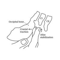 The concept of alternative medicine occipital and atlas correction. Treatment of the occipital diaphragm with hands. Craniosacral therapy session. Illustration isolated on white background vector