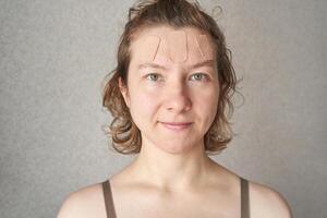 Caucasian female adult with acne patches on forehead smiling at camera in casual attire on neutral background. photo
