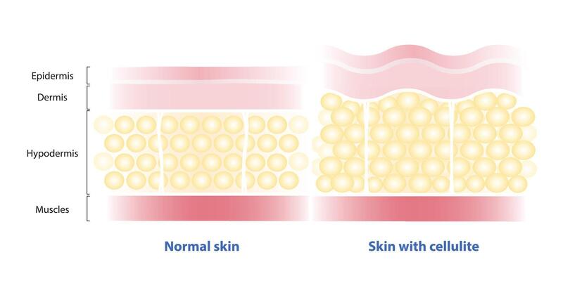 Comparison of normal skin and skin with cellulite illustration isolated on white background. The fat cells enlarged, connective tissue stretched. The skin dimpling, looks like orange peel.
