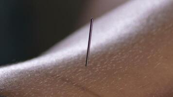 Acupuncture needle spike in the back of a woman in a acupuncture session video