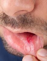 Man shows his lower lip with aphtha photo