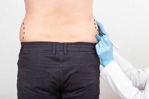 The plastic surgeon makes marks with a marker on the problem areas of the patient's thighs. Fat removal concept with plastic surgery, liposuction photo