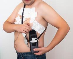 An obese man undergoes a Holter monitoring of the heart. Control of blood supply and disorders of the heart after myocardial infarction, electrocardiogram photo