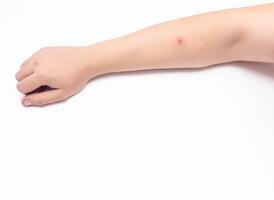 Red sore pimple on a person's hand, white background, close-up, copy space, inflammation photo
