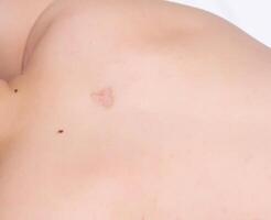 Scar on a man's back after removal of an inflamed boil, scar, close-up, copy space, healthcare photo