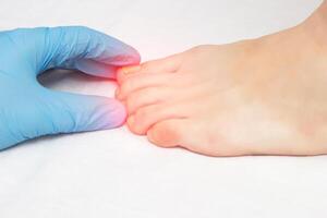 Doctor examines ingrown nail on female leg and fungus diseases, mycosis, close-up, white background, pain photo