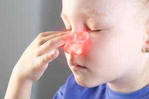 A girl is holding her red nose whose skin is irritated due to a runny nose. Pain in the maxillary sinuses, runny nose. photo