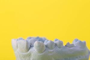 Blue plaster model of an impression of a patient's jaw at an orthodontist dentist on a yellow background. Manufacturing of dentures and crowns for dental prosthetics in orthodontics, macro. photo