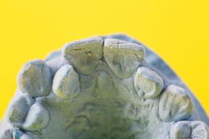 Blue plaster impression of a patient's dental jaw with crooked teeth and malocclusions on a yellow background. Manufacturing of braces to correct bite. View from above. Copy space for text photo