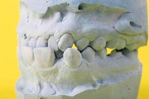 Blue plaster impression of the dental jaw of a patient with crooked teeth and malocclusions. Manufacturing of dentures and crowns based on orthodontic impressions, close-up photo