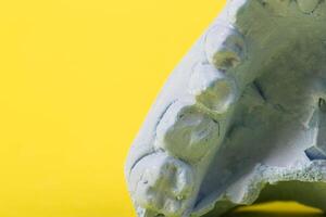 Blue plaster impression of a patient's dental jaw with crooked teeth and malocclusions on a yellow background. Manufacturing of bridges, crowns of various types, macro. Copy space for text photo