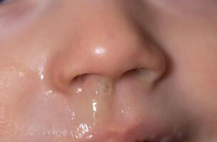 Close-up of a small child's face and nose with snot. The concept of colds, rhinitis and runny nose in children. photo
