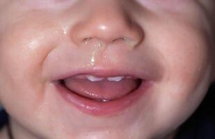 Close-up of a child's face, nose with snot and teething in the child's mouth. Concept of the reaction of snot from the nose to teething, therapy photo