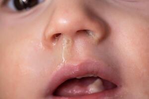 Yellow snot from a child s nose, close-up. Sinus infections, colds and virus. Chronic runny nose, adenoviruses photo