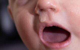Yellow snot from a child s nose, close-up. Sinus infections, colds and virus. Chronic runny nose, adenoviruses photo