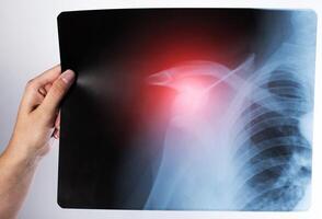 The doctor holds in his hand an x-ray of a dislocated shoulder joint and a fracture of the humerus. Inflammation and synovitis at the site of injury, close-up photo