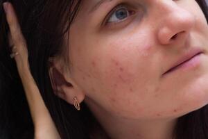 Portrait of a brunette girl with acne on her face, red pimples on the face of a young girl, close-up, caucasian photo