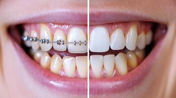 Before and after comparison of teeth undergoing orthodontic treatment for improved alignment photo