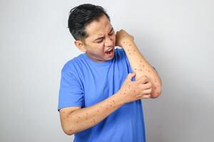 Concept of monkey pox infection, a white Asian man with pustular skin from monkeypox virus infection. photo