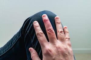 Mallet finger healing after splint removal from middle finger following joint trauma photo