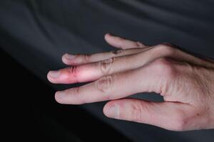 Mallet finger healing after splint removal from middle finger following joint trauma photo