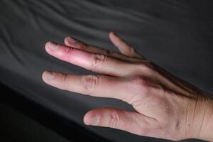 Mallet finger healing after splint removal from middle finger following joint trauma photo